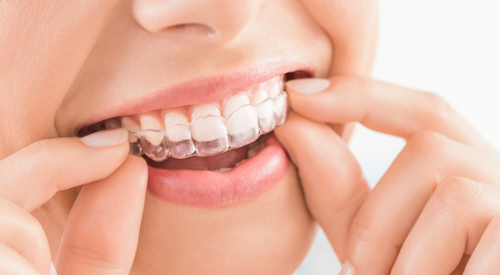Invisalign_Johnson_City_dentist